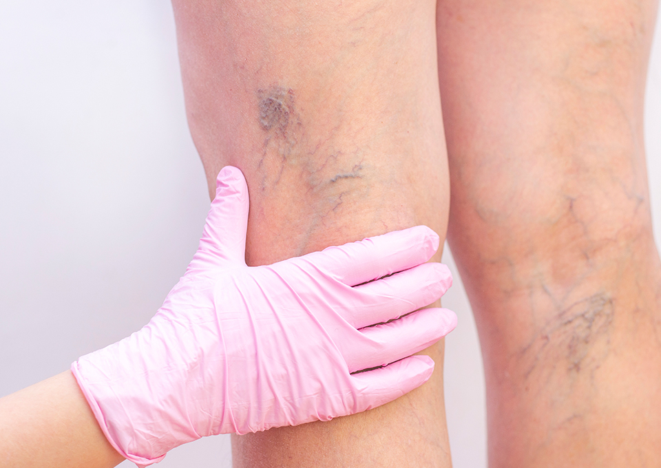 Kılcal Varis Tedavisi